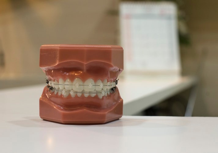 Aparelho Dentário: autoligado x fixo. Qual o melhor?